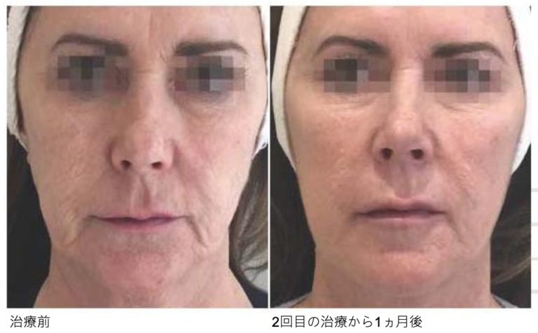 プロファイロの症例写真