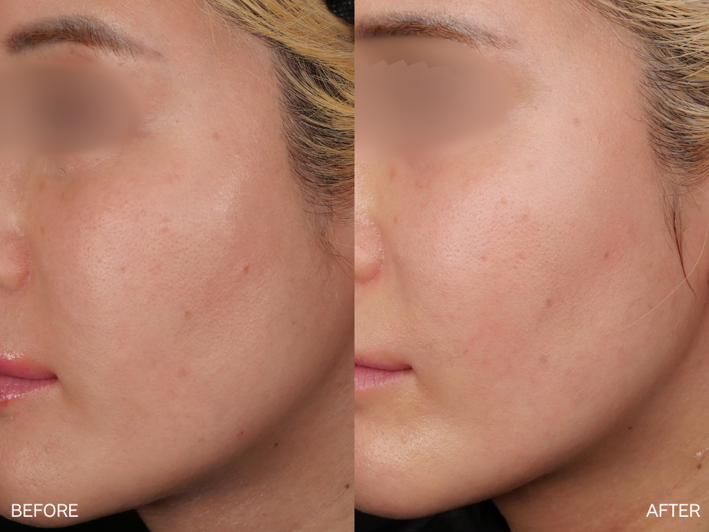 リジュラン2cc+スキンボトックスを1回注入