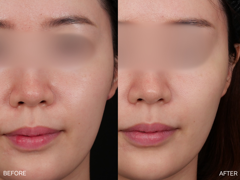 リジュラン2cc+スキンボトックスを1回注入