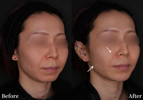 ヒアルロン酸3cc注入