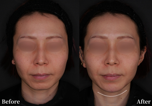 ヒアルロン酸3cc注入