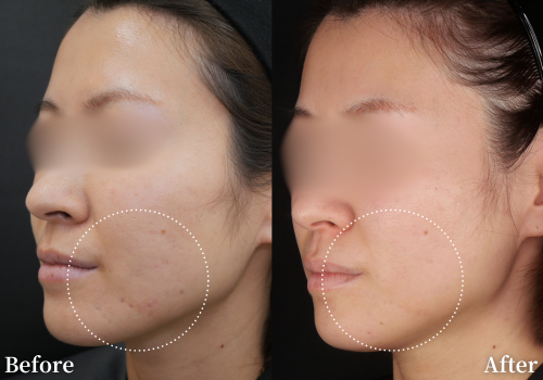 ジュベルック注射（1cc）手打ち ※麻酔クリーム・初診料込 ジュベルック注射（1cc）手打ち \u203b麻酔クリーム・初診料込