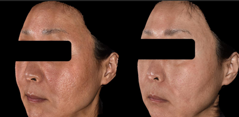 ジュベルック3cc ドクター手打ち 2回施術 症例写真1