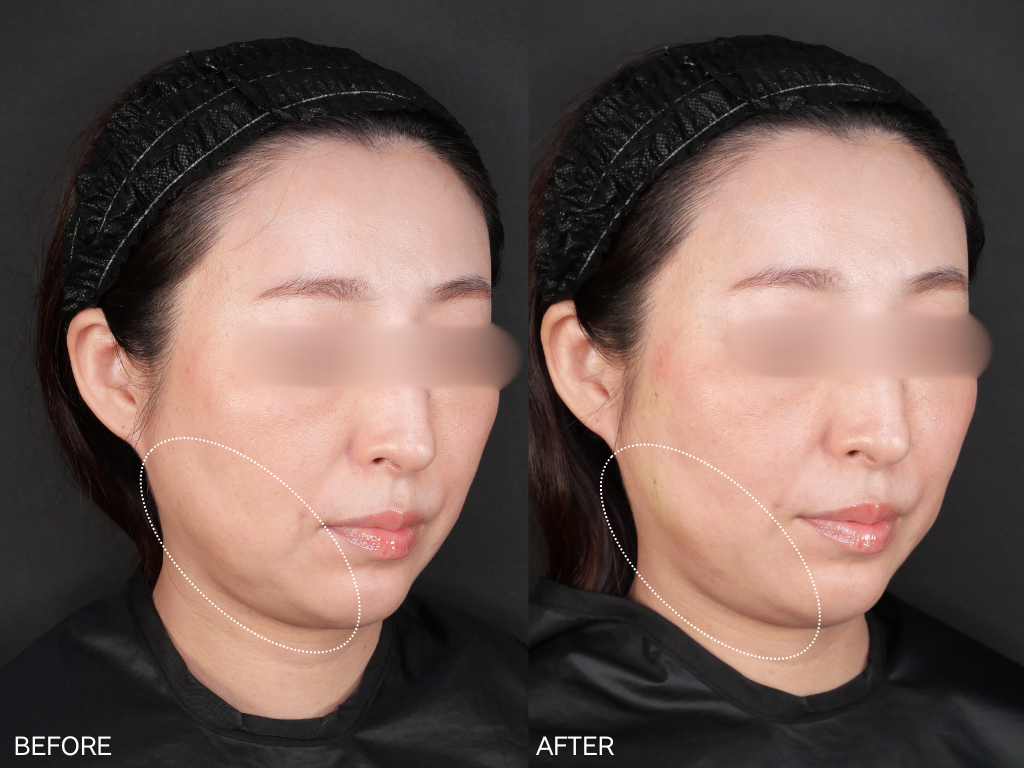 Nスキャホールド10本