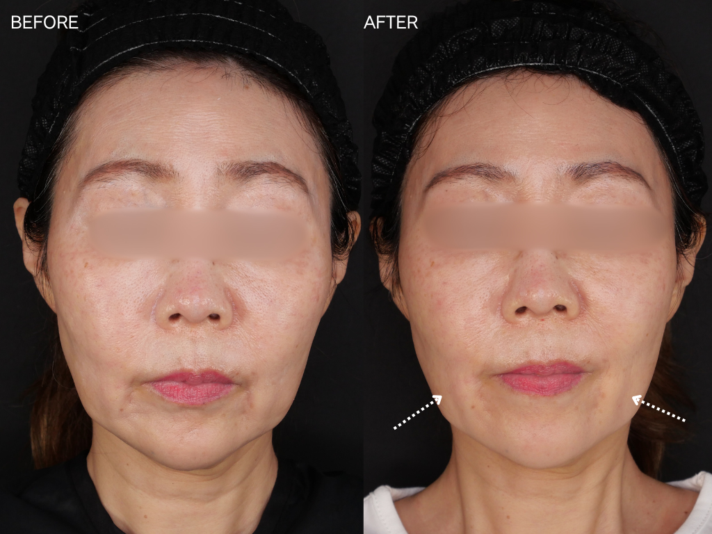 Nスキャホールド10本