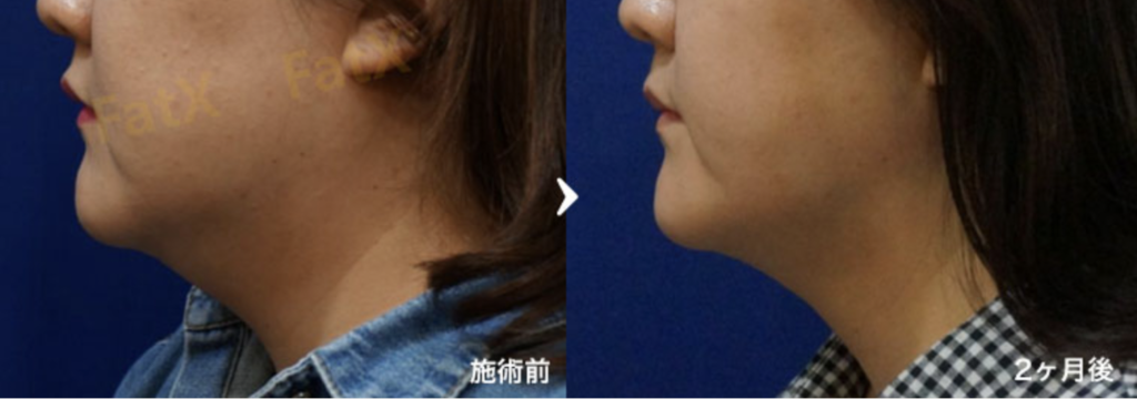 FatX core（脂肪溶解注射）4.5mLを1回注射 症例写真1