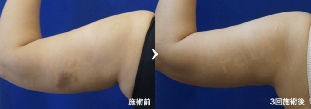 FatX core（脂肪溶解注射）1回目（4cc）2回目（4cc）3回目（3cc）を注射 症例写真1