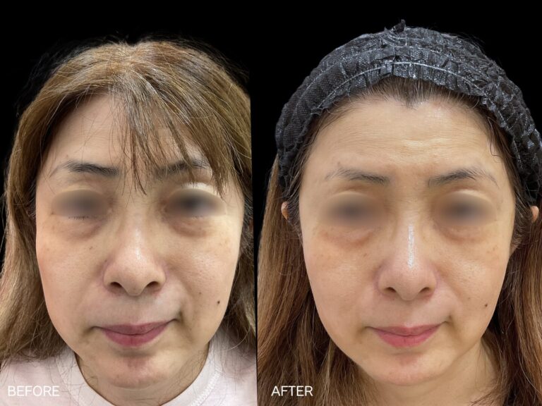 DRモフィウス（目のクマ） 症例写真1