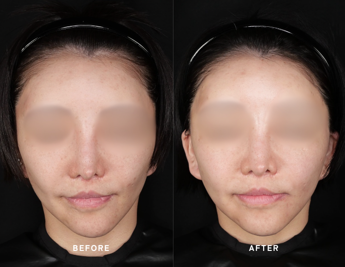 ジャルプロスーパーハイドロ1回