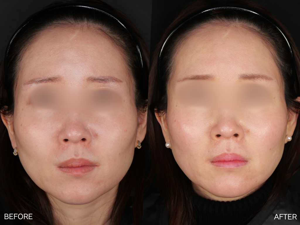 プルリアル　デンシファイ1回