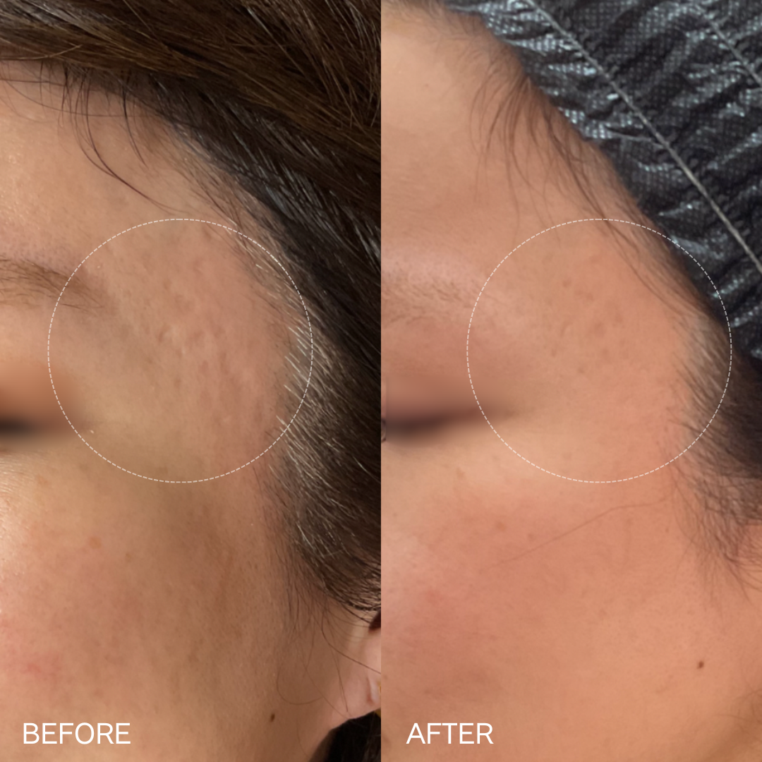 ドクターサブシジョン（3cm × 3cm）3回