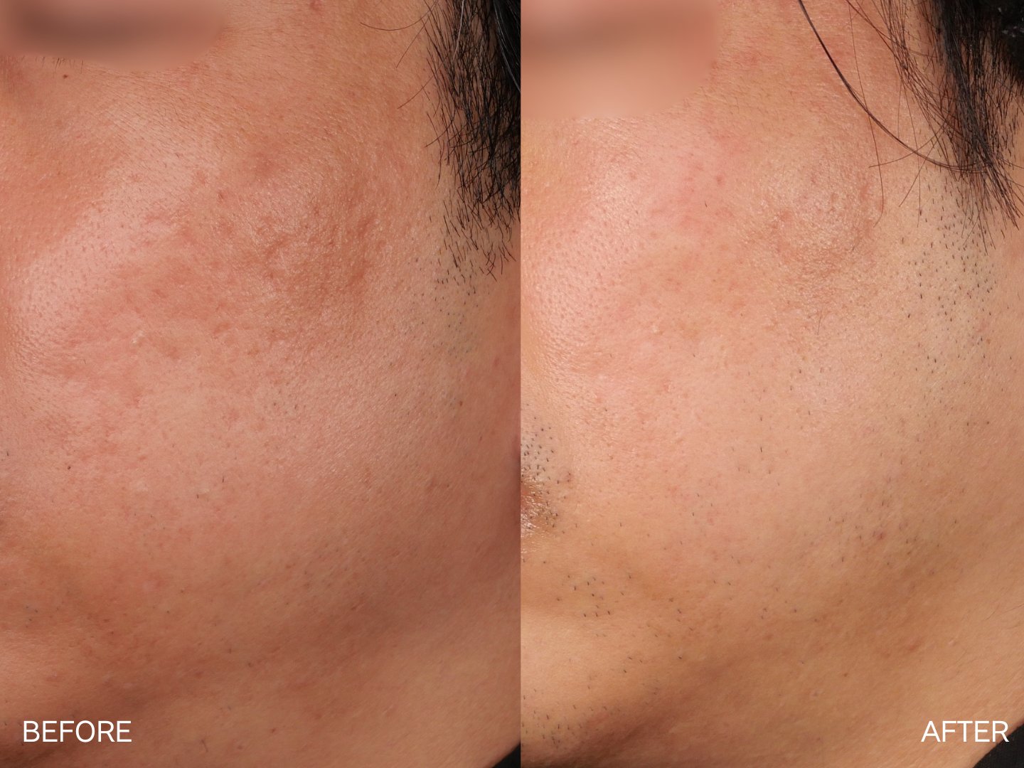 ドクターサブシジョン(5cm×5cm）3回