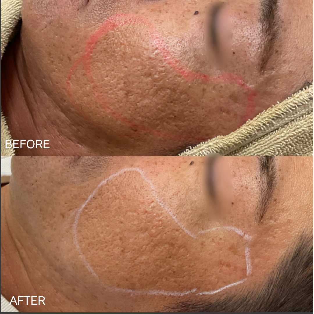 ドクターサブシジョン（7cm × 7cm）2回