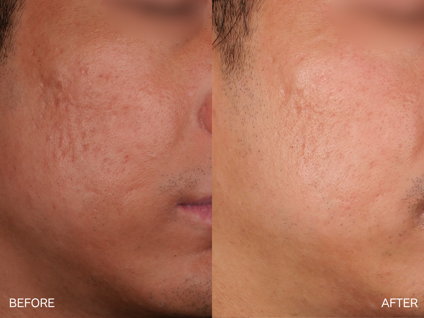 ドクターサブシジョン(5cm×5cm）3回