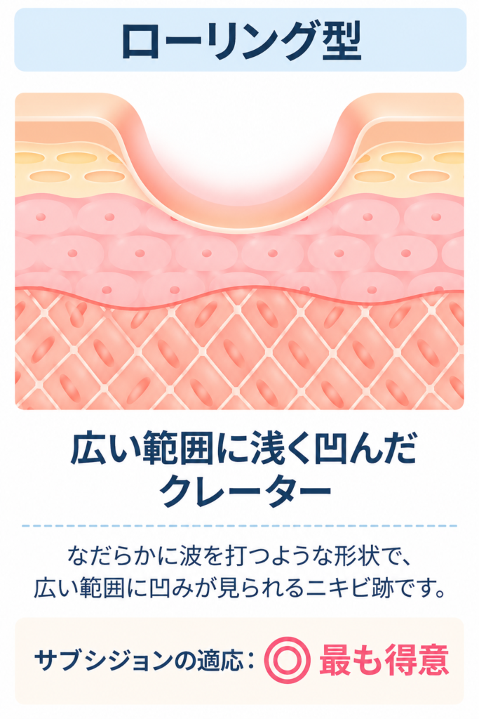 ローリング型