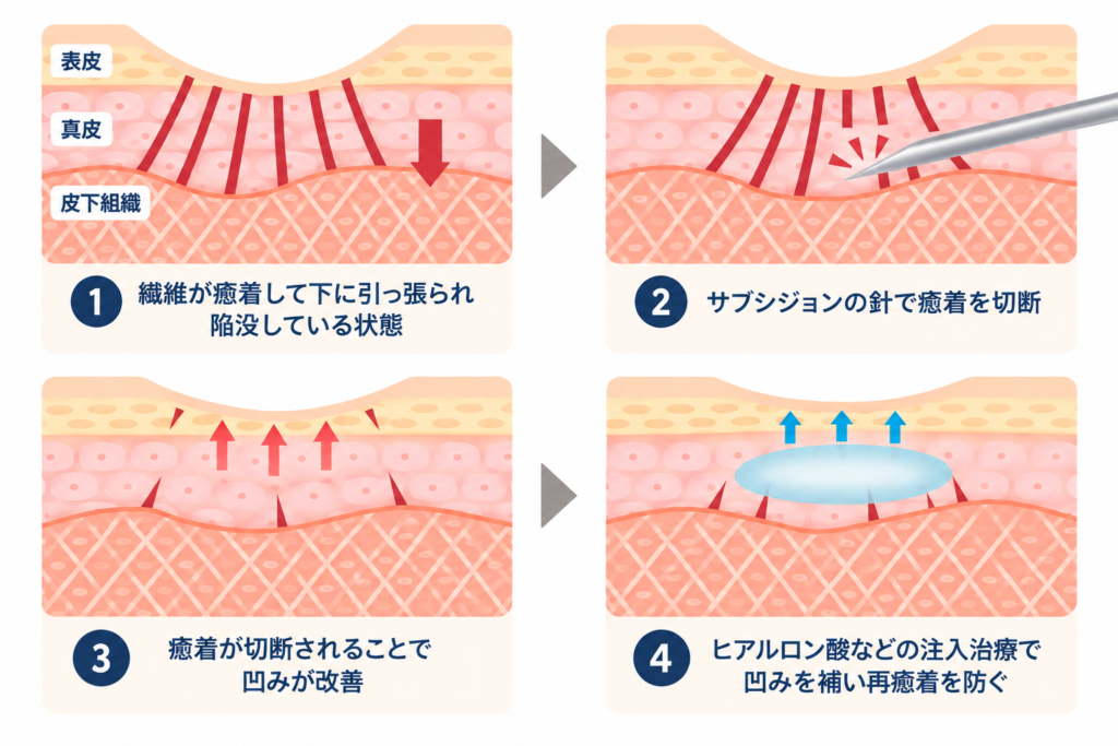にきび跡の凹み（クレーター）の改善