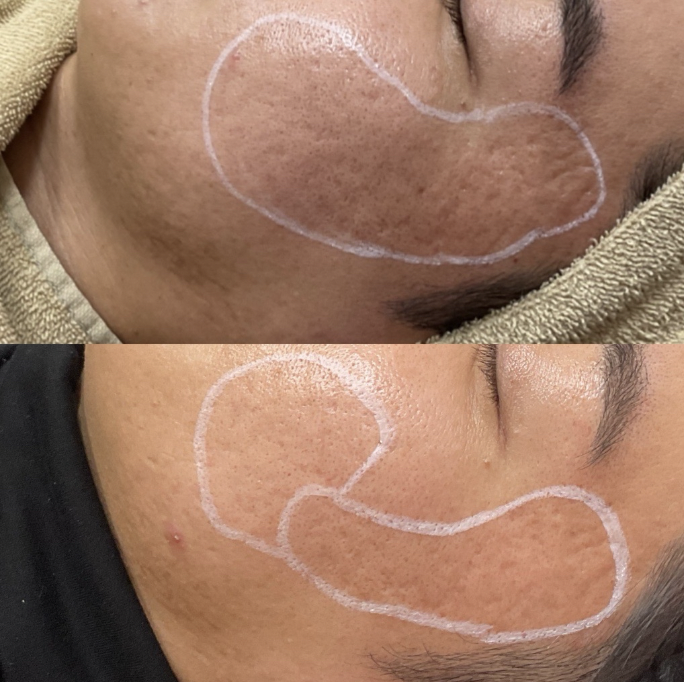 ドクターサブシジョン（7cm × 7cm）1回