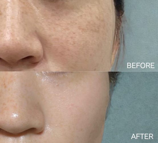 KOダブル1回施術