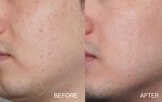 キュアジェット5回