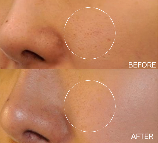 キュアジェット1回