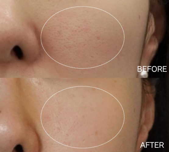 キュアジェット1回