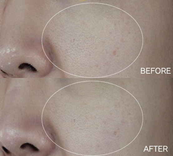 キュアジェット3回