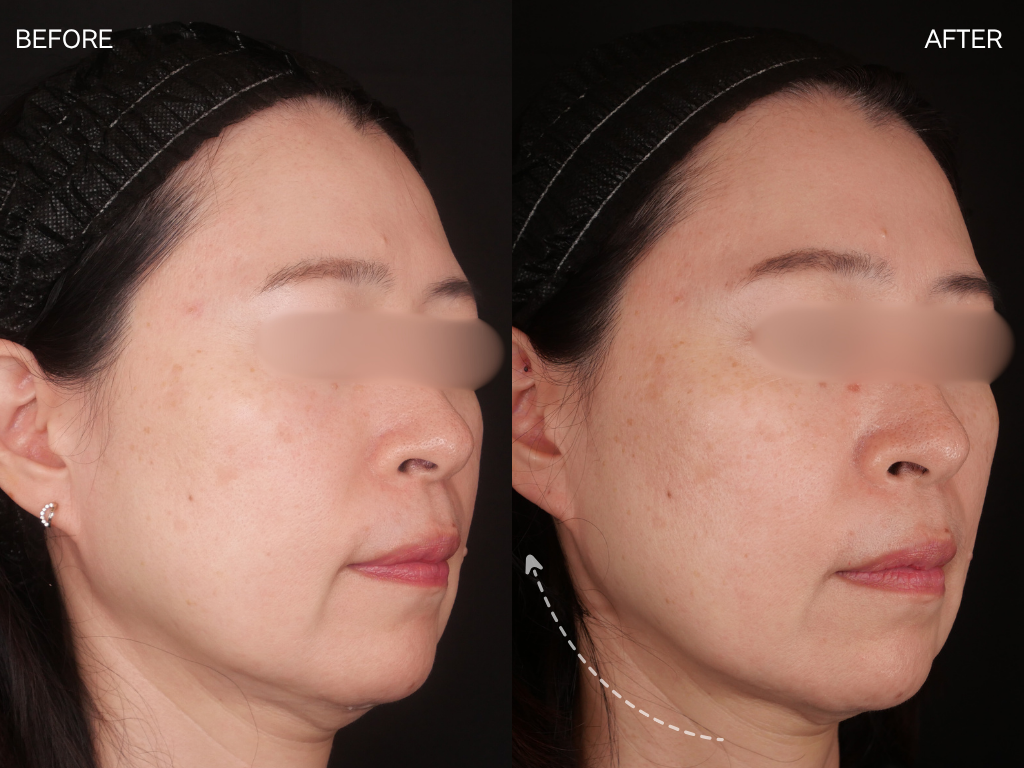 ジャルプロスーパーハイドロ1回