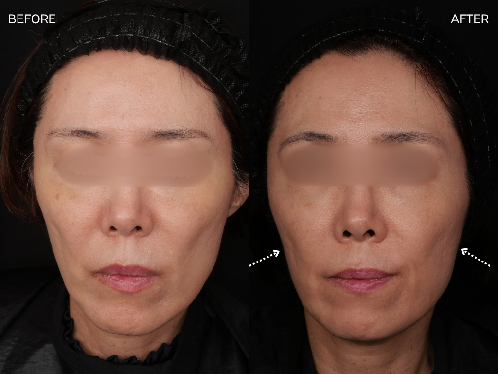 ジャルプロスーパーハイドロ2回