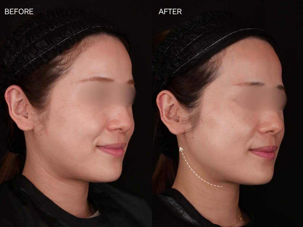 ジャルプロスーパーハイドロ1回