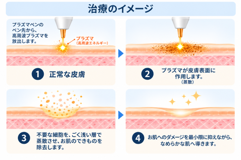 いぼ・首いぼ取り（プラズマペン）