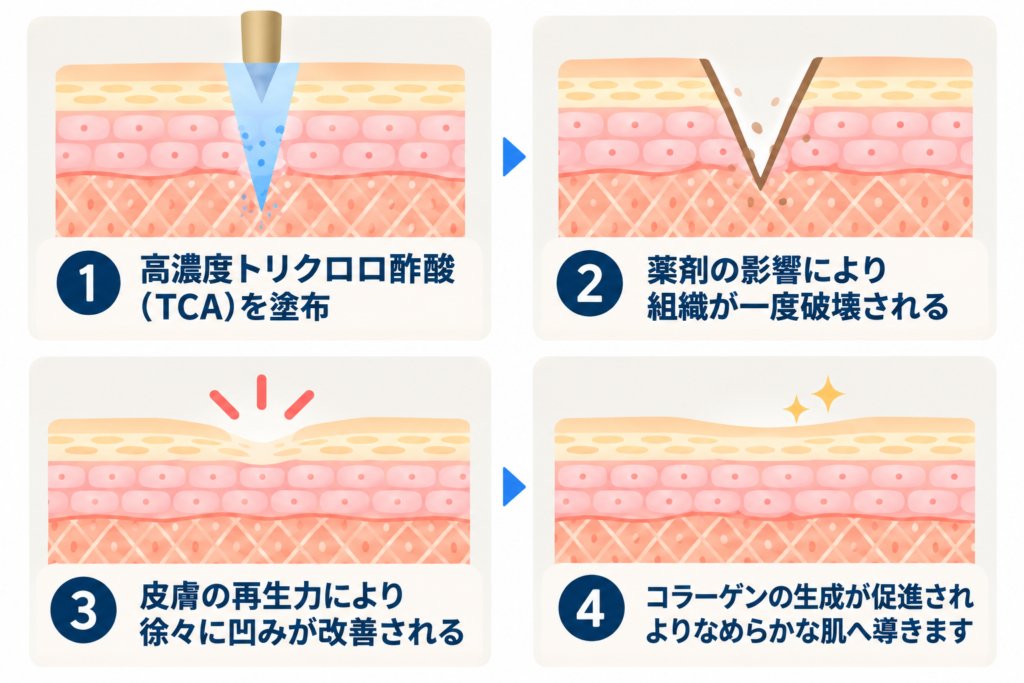 にきび跡の凹みの改善
