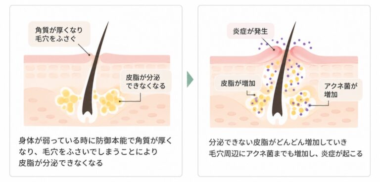 ニキビができる仕組みの図。左：身体が弱っている時に防御本能で角質が厚くなって毛穴をふさぎ、皮脂が分泌できなくなる。右：分泌できない皮脂が増え、毛穴周辺にアクネ菌も増えて炎症が起こる
